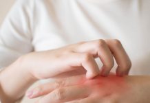 Salud en la piel | Dermatitis
